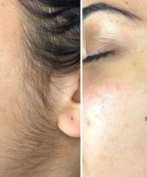 Dermaplaning vs Shaving Dermaplaning vs Shaving